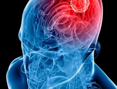 Όγκος στο κεφάλι: Πώς θα τον καταλάβετε- Ποιοι κινδυνεύουν